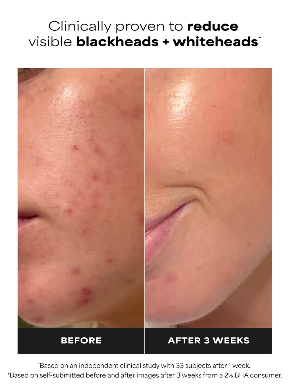 Paula’s Choice 2% BHA visible skin texture results